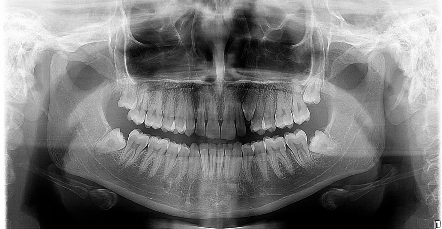 Radiografia Panorâmica
