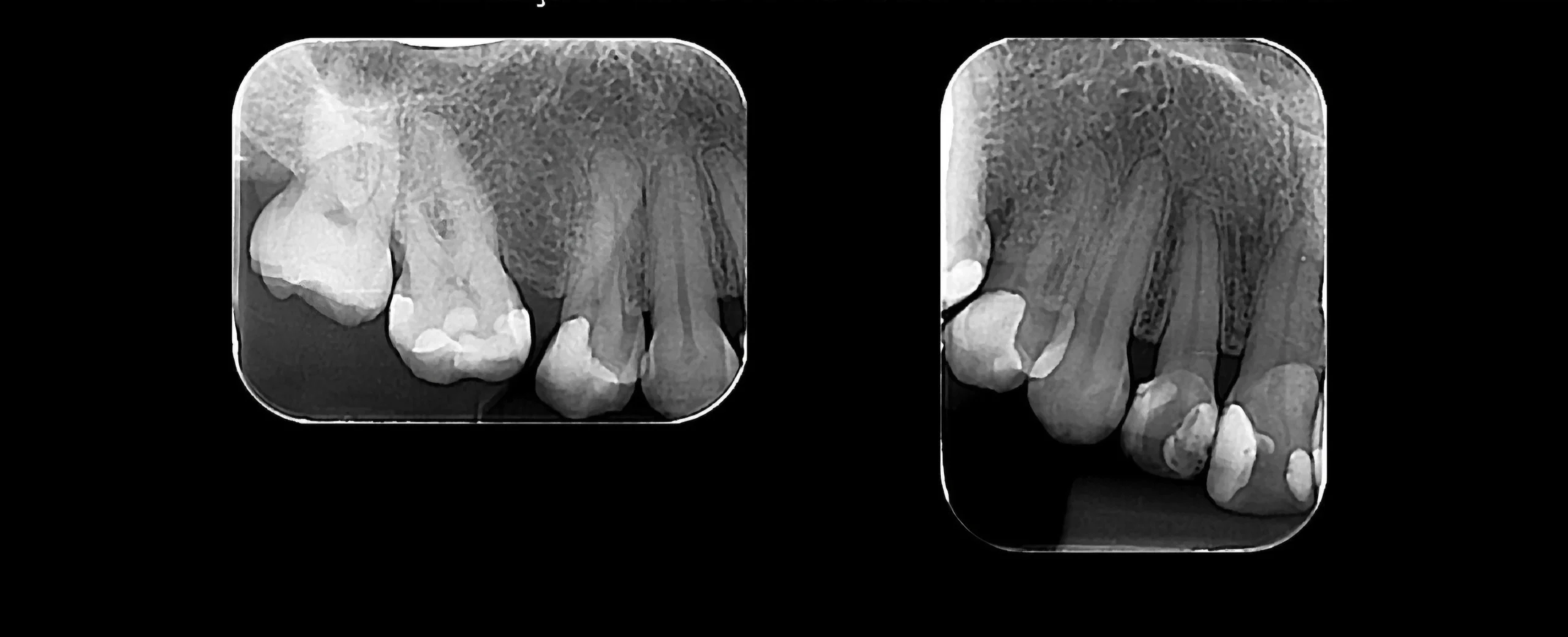 Radiografia Periapical