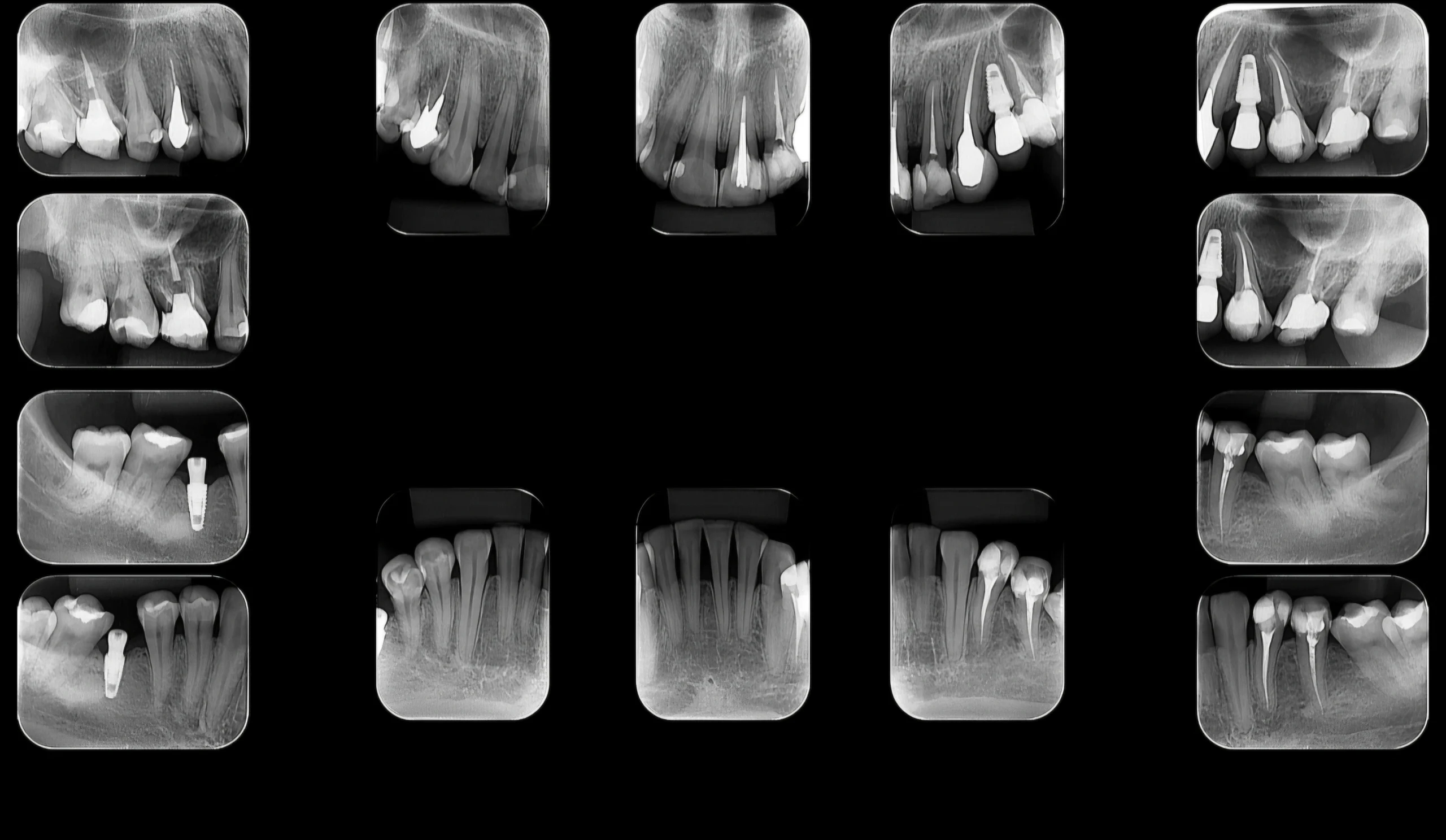 Levantamento Periapical Completo