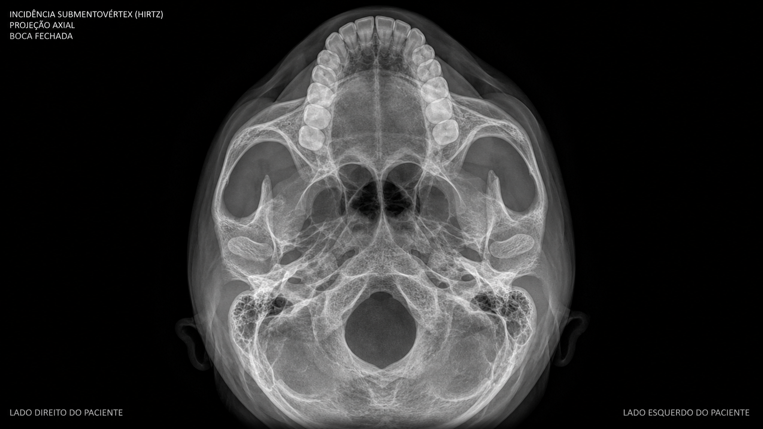 img-axial-hirtz