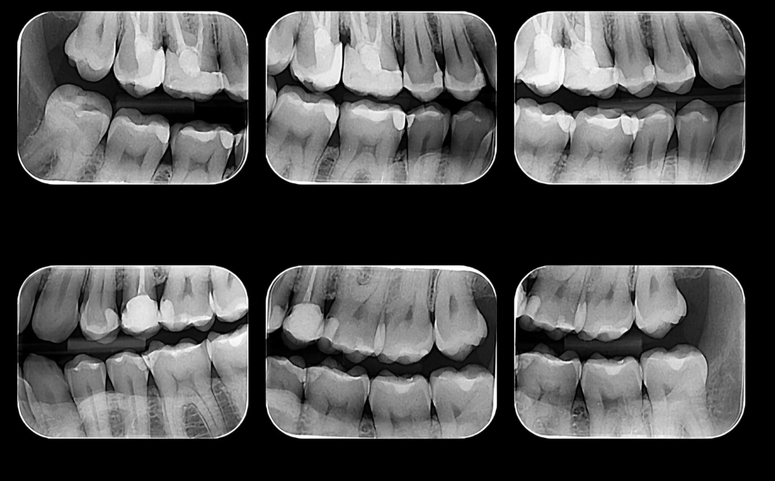 Radiografia Interproximal