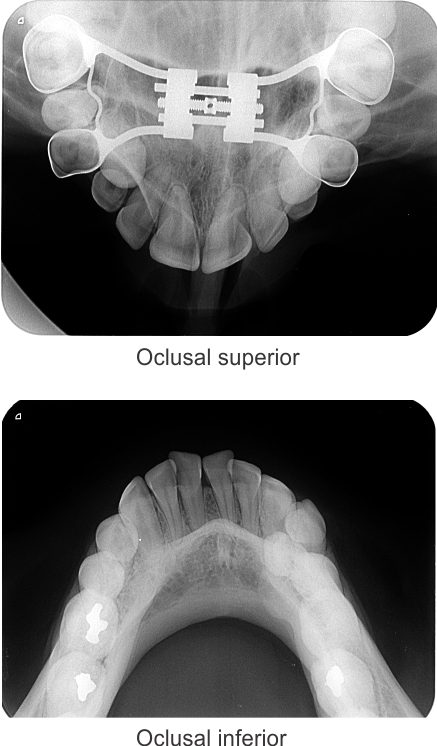 img-oclusal