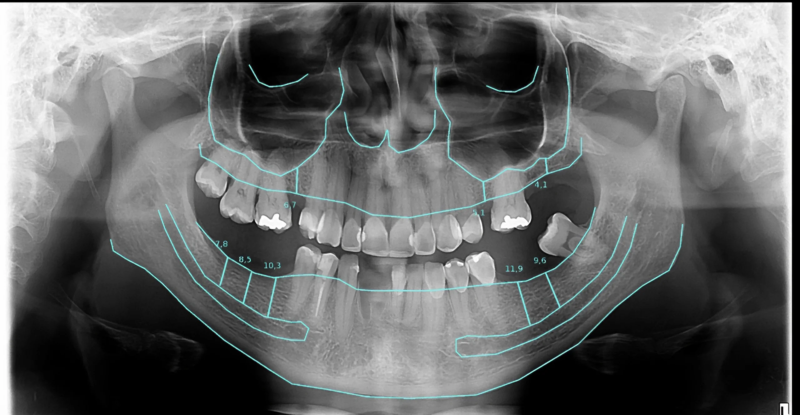 Radiografia Panorâmica para implante