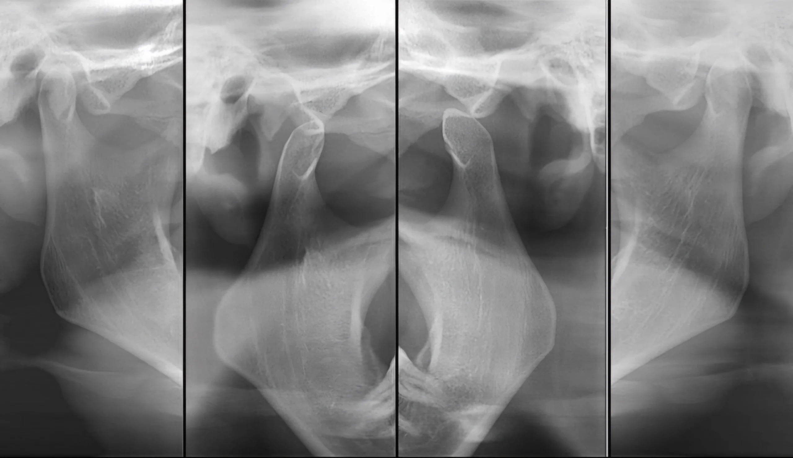 Radiografia ATM